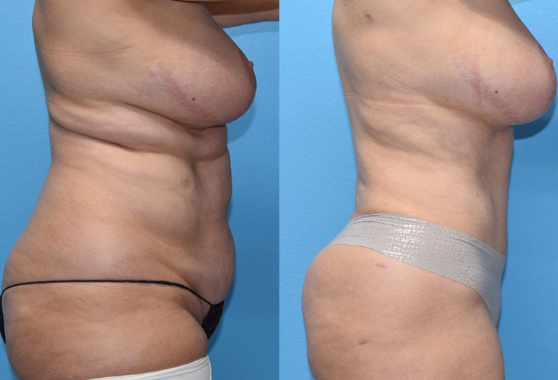 Tummy tuck results by Dr. Maningas at Maningas Cosmetic Surgery in Joplin, MO