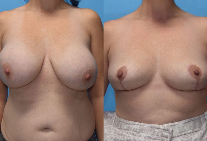 Cosmetic breast revision results by Dr. Maningas at Maningas Cosmetic Surgery in Missouri and Arkansas