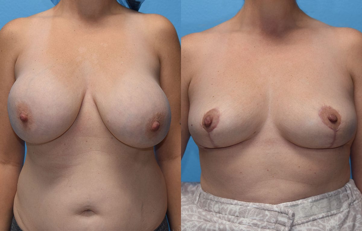 Cosmetic breast revision results by Dr. Maningas at Maningas Cosmetic Surgery in Missouri and Arkansas