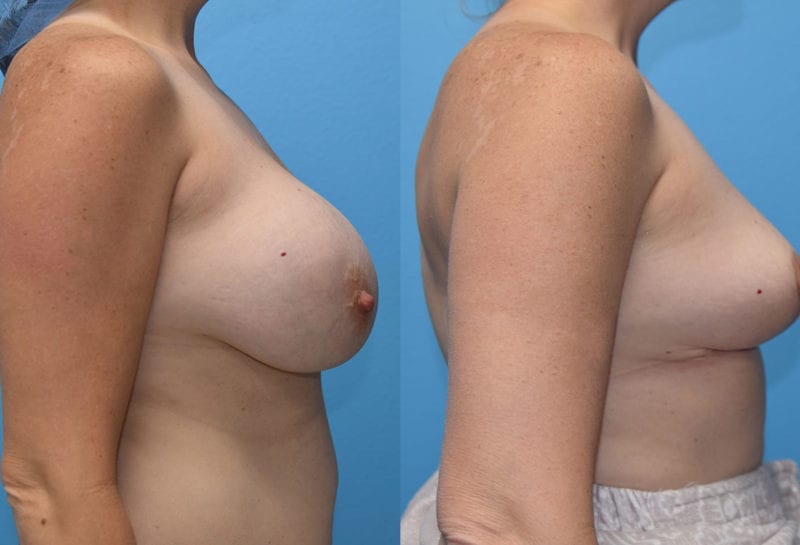 Cosmetic breast revision results by Dr. Maningas at Maningas Cosmetic Surgery in Missouri and Arkansas