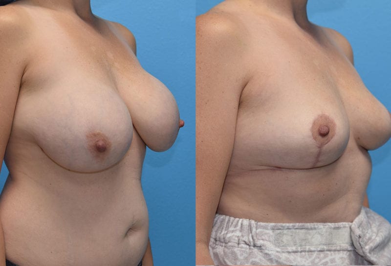 Cosmetic breast revision results by Dr. Maningas at Maningas Cosmetic Surgery in Missouri and Arkansas