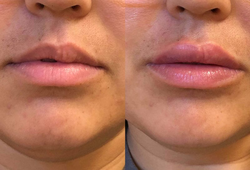 Lip Filler in Joplin, MO at Maningas Cosmetics Surgery