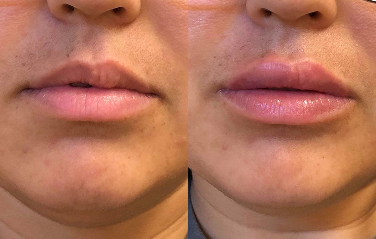 Lip Filler in Joplin, MO at Maningas Cosmetics Surgery