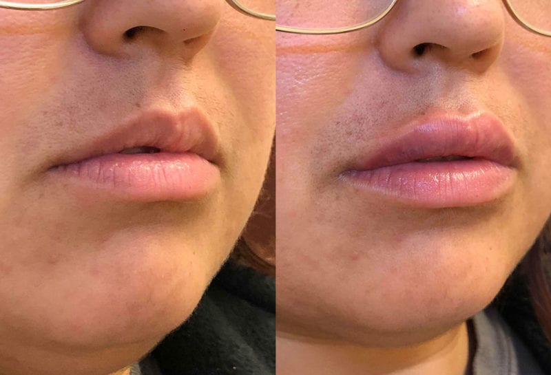 Lip Filler in Joplin, MO at Maningas Cosmetics Surgery