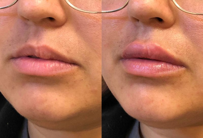 Lip Filler in Joplin, MO at Maningas Cosmetics Surgery