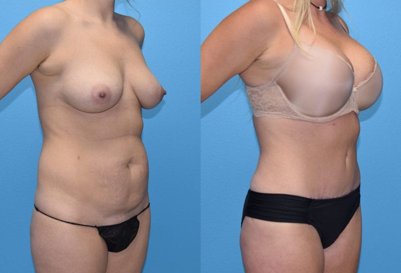 Mommy Makeover results by Dr. Maningas at Maningas Cosmetic Surgery in Joplin, MO