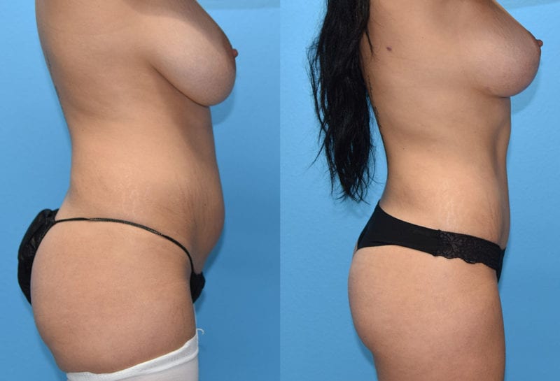 Tummy tuck results by Dr. Maningas at Maningas Cosmetic Surgery in Joplin, MO