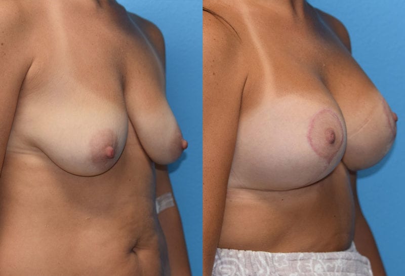 Breast Lift with Implant results by Dr. Maningas at Maningas Cosmetic Surgery in Missouri and Arkansas