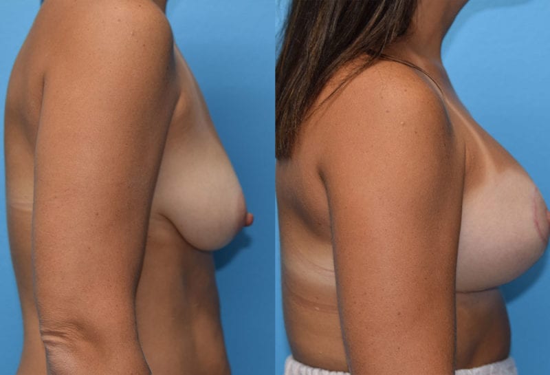 Breast Lift with Implant results by Dr. Maningas at Maningas Cosmetic Surgery in Missouri and Arkansas