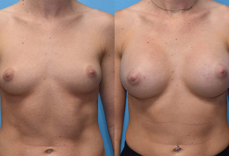 breast augmentation results by dr. maningas at maningas cosmetic surgery in joplin, mo