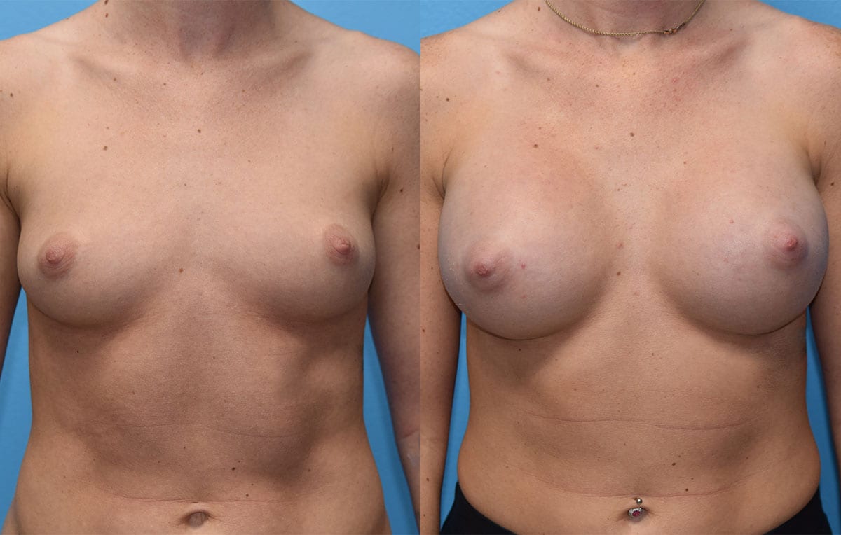 breast augmentation results by dr. maningas at maningas cosmetic surgery in joplin, mo