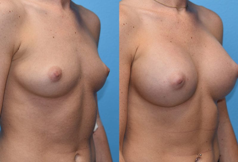 breast augmentation results by dr. maningas at maningas cosmetic surgery in joplin, mo