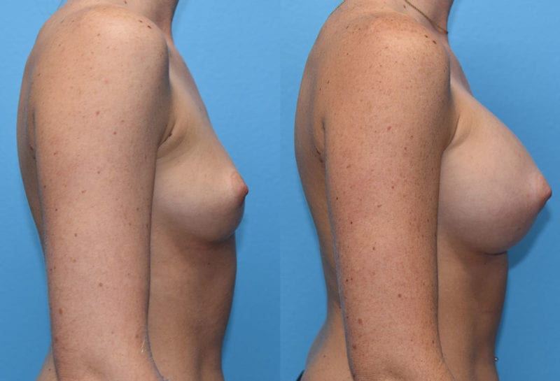 breast augmentation results by dr. maningas at maningas cosmetic surgery in joplin, mo