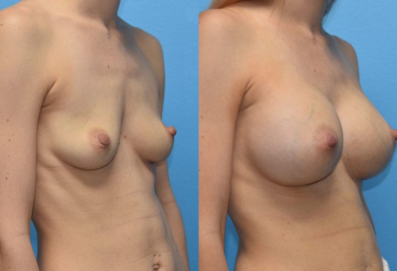 breast augmentation results by dr. maningas at maningas cosmetic surgery in joplin, mo