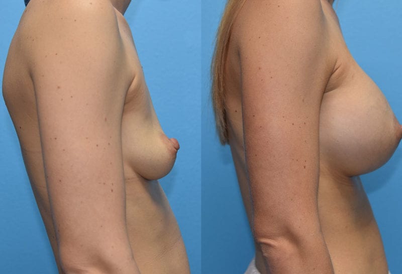 breast augmentation results by dr. maningas at maningas cosmetic surgery in joplin, mo