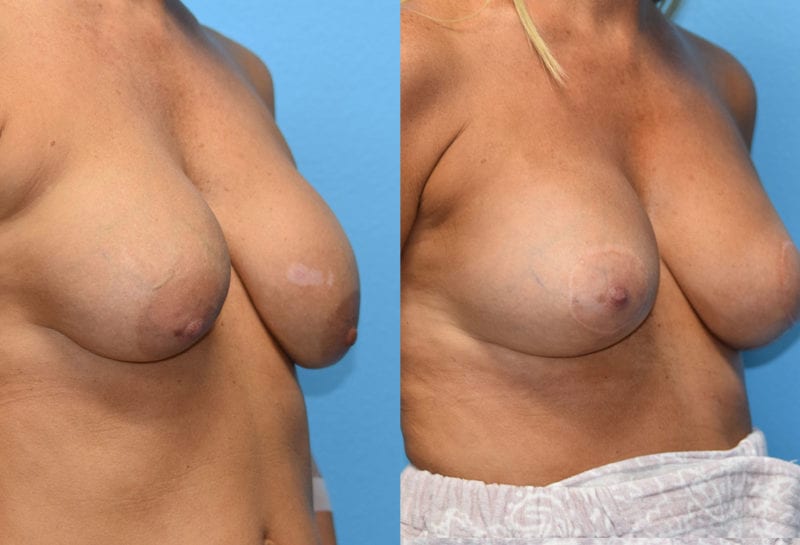 Cosmetic breast revision results by Dr. Maningas at Maningas Cosmetic Surgery in Missouri and Arkansas