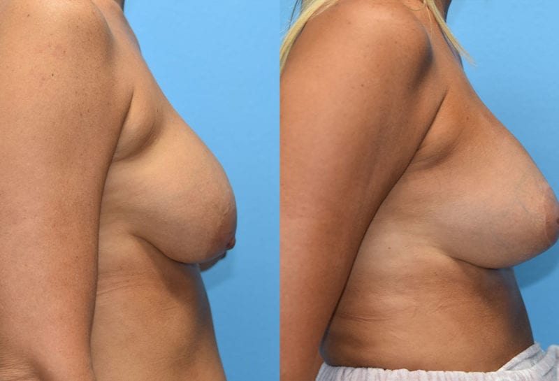 Cosmetic breast revision results by Dr. Maningas at Maningas Cosmetic Surgery in Missouri and Arkansas