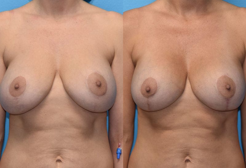 Cosmetic breast revision results by Dr. Maningas at Maningas Cosmetic Surgery in Missouri and Arkansas