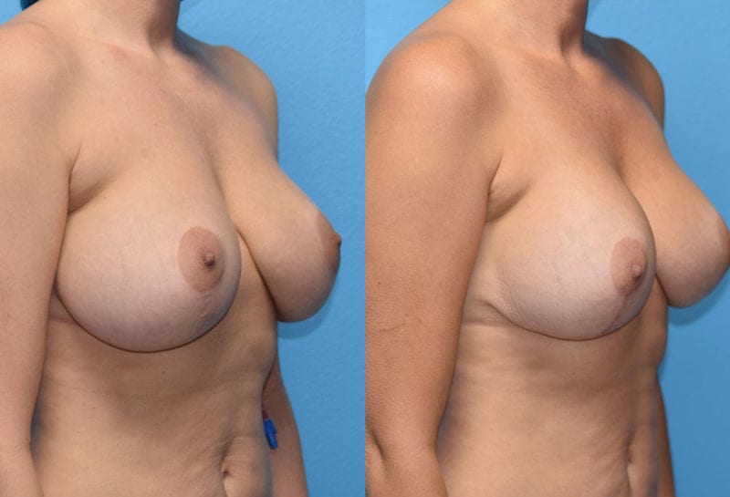 Cosmetic breast revision results by Dr. Maningas at Maningas Cosmetic Surgery in Missouri and Arkansas