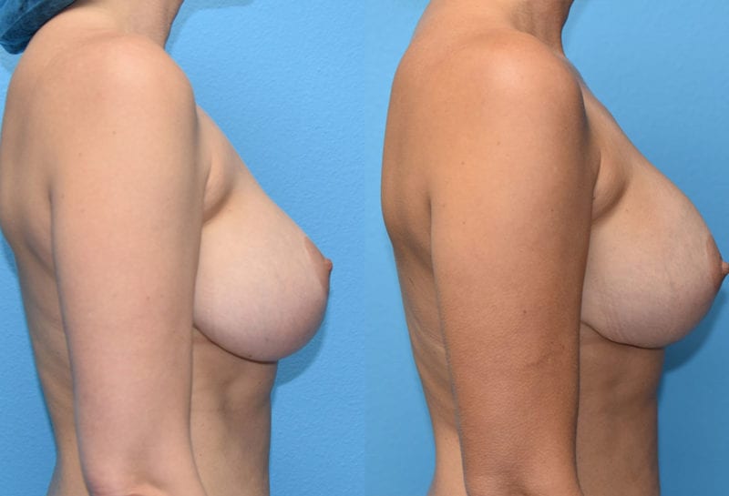 Cosmetic breast revision results by Dr. Maningas at Maningas Cosmetic Surgery in Missouri and Arkansas