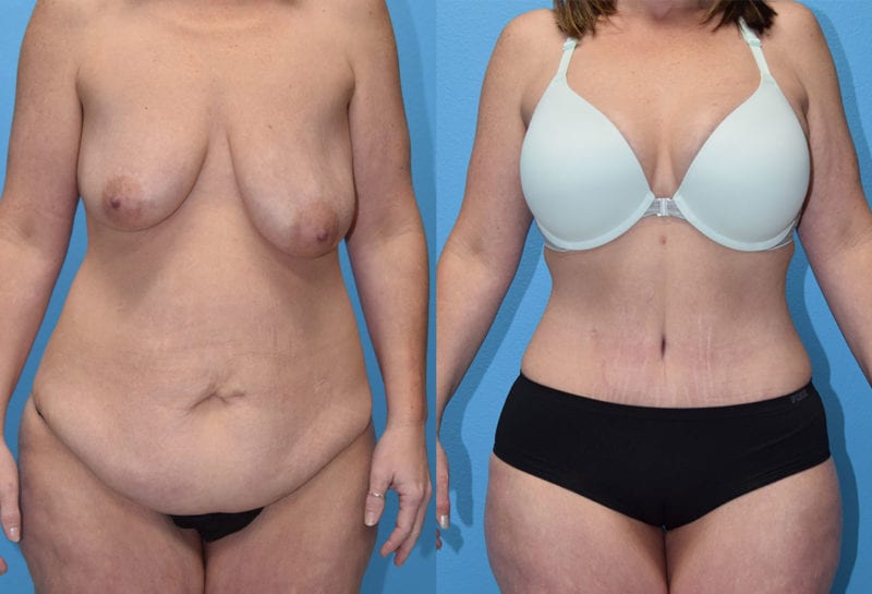 Tummy tuck results by Dr. Maningas at Maningas Cosmetic Surgery in Joplin, MO