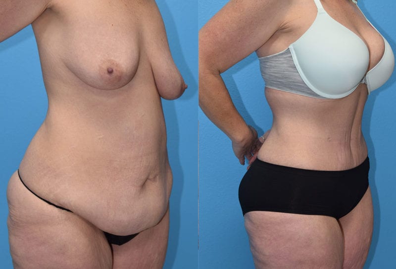 Tummy tuck results by Dr. Maningas at Maningas Cosmetic Surgery in Joplin, MO