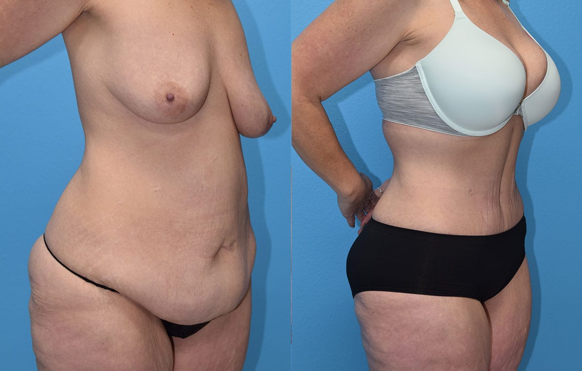 Tummy tuck results by Dr. Maningas at Maningas Cosmetic Surgery in Joplin, MO