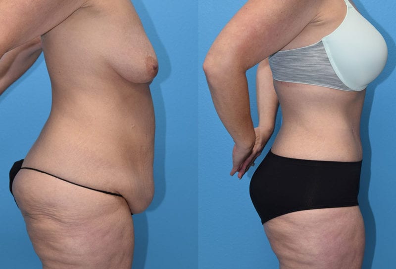 Tummy tuck results by Dr. Maningas at Maningas Cosmetic Surgery in Joplin, MO