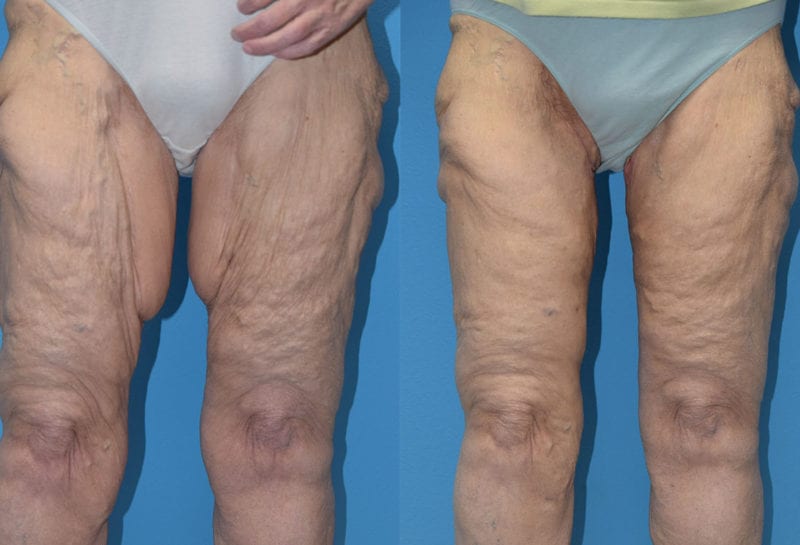 Inner Thigh Lift by Dr. Maningas at Maningas Cosmetic Surgery in Joplin, MO