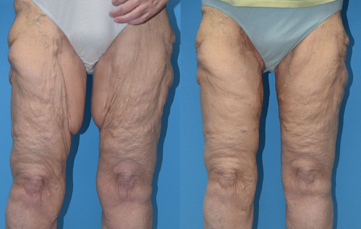 Inner Thigh Lift by Dr. Maningas at Maningas Cosmetic Surgery in Joplin, MO