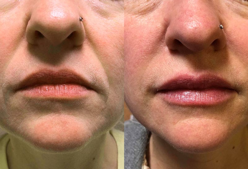 Lip Filler in Joplin, MO at Maningas Cosmetics Surgery