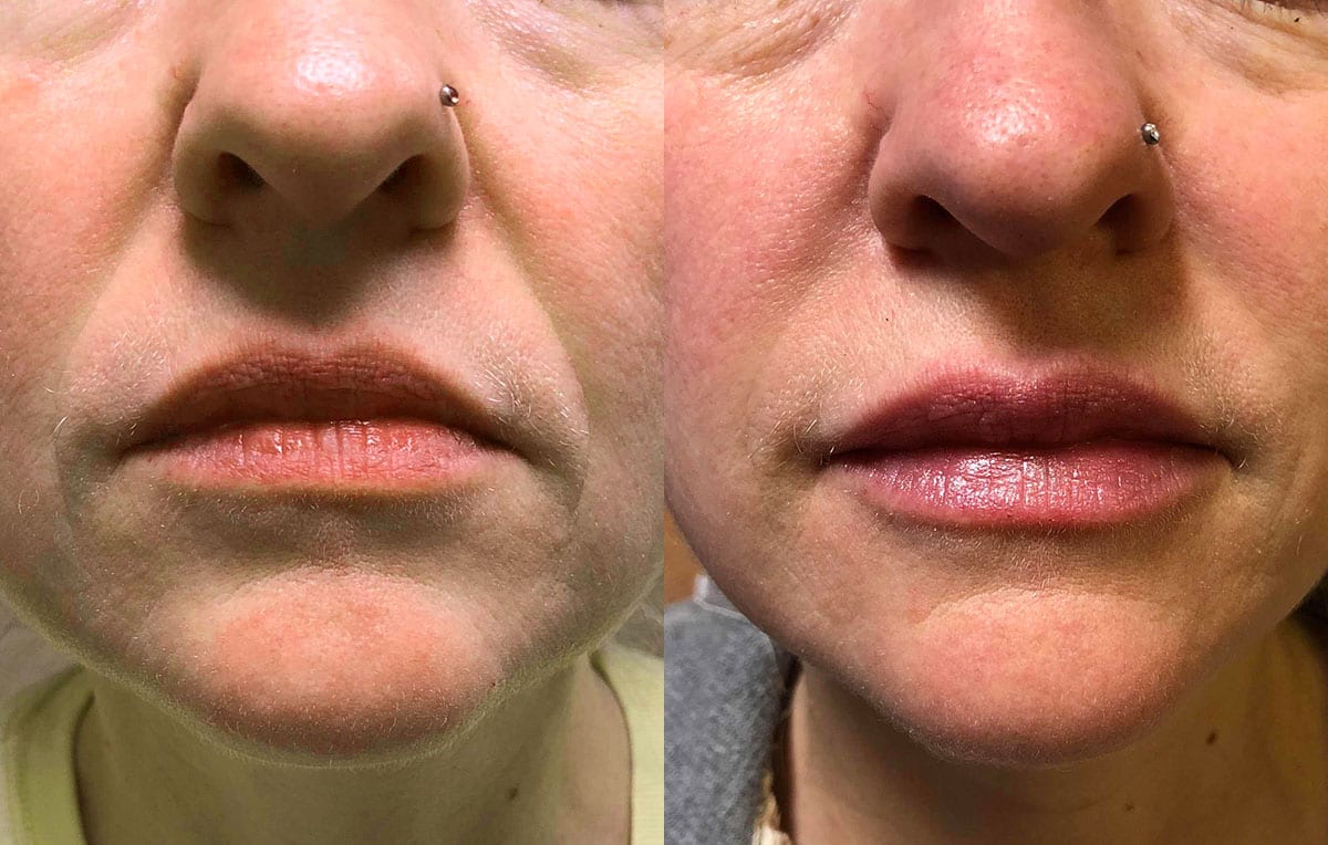 Lip Filler in Joplin, MO at Maningas Cosmetics Surgery