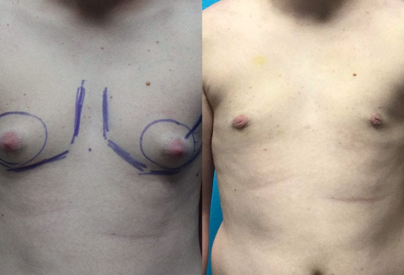 Gynecomastia Repair, or Male Breast Reduction, results by Dr. Maningas at Maningas Cosmetic Surgery in Joplin, MO and Northwest Arkansas