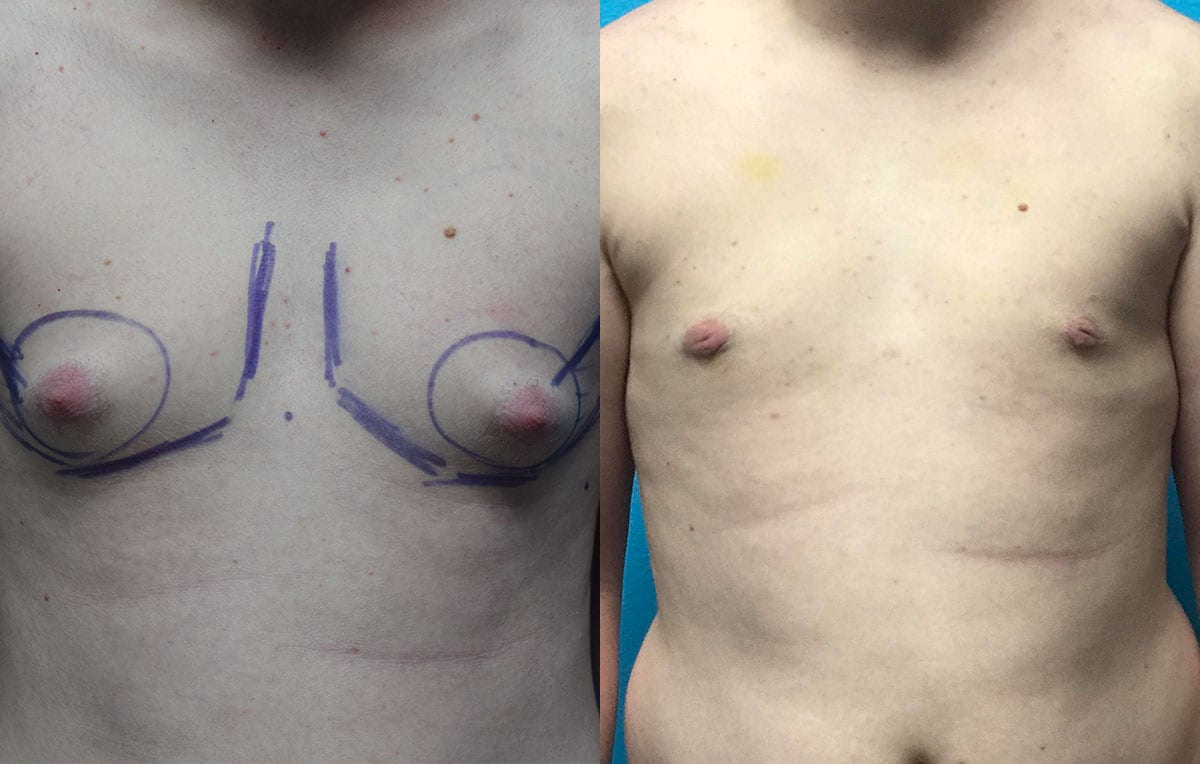 Gynecomastia Repair, or Male Breast Reduction, results by Dr. Maningas at Maningas Cosmetic Surgery in Joplin, MO and Northwest Arkansas