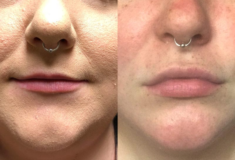 Lip Filler in Joplin, MO at Maningas Cosmetics Surgery