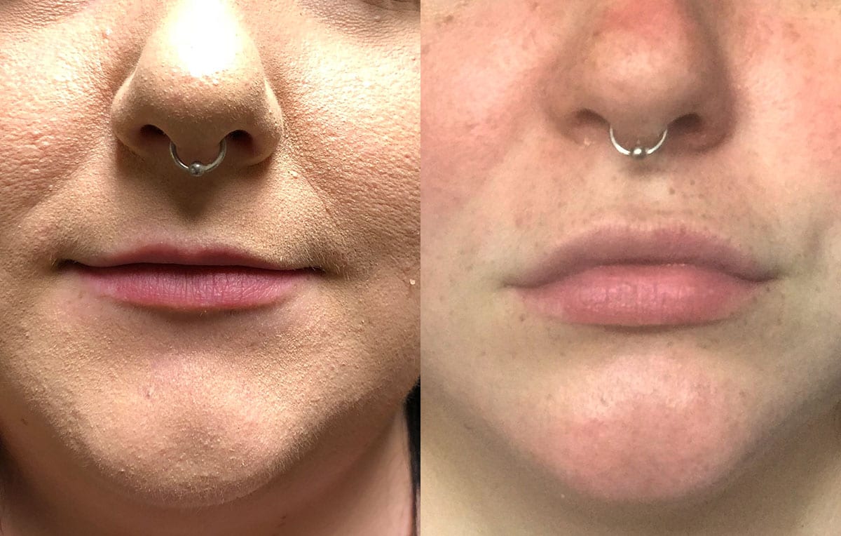 Lip Filler in Joplin, MO at Maningas Cosmetics Surgery