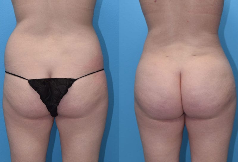 Brazilian Butt Lift by Dr. Maningas at Maningas Cosmetic Surgery in Joplin, MO