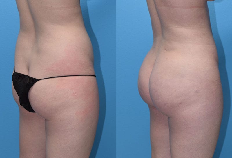 Brazilian Butt Lift by Dr. Maningas at Maningas Cosmetic Surgery in Joplin, MO