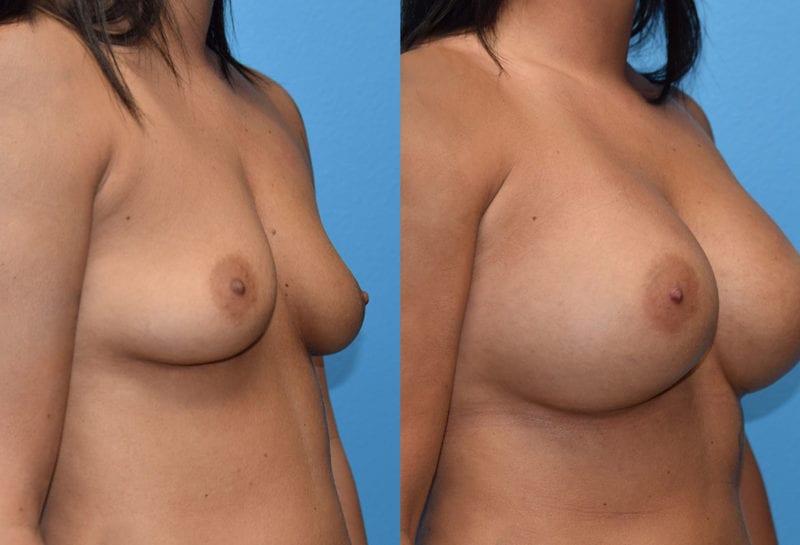 breast augmentation results by dr. maningas at maningas cosmetic surgery in joplin, mo