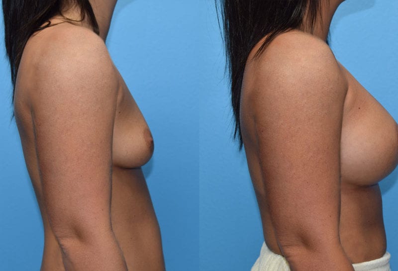 breast augmentation results by dr. maningas at maningas cosmetic surgery in joplin, mo