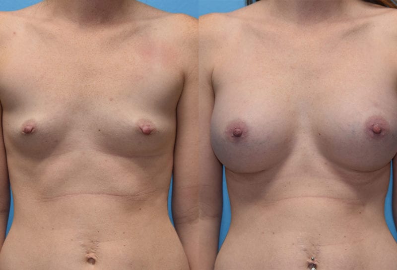 breast augmentation results by dr. maningas at maningas cosmetic surgery in joplin, mo