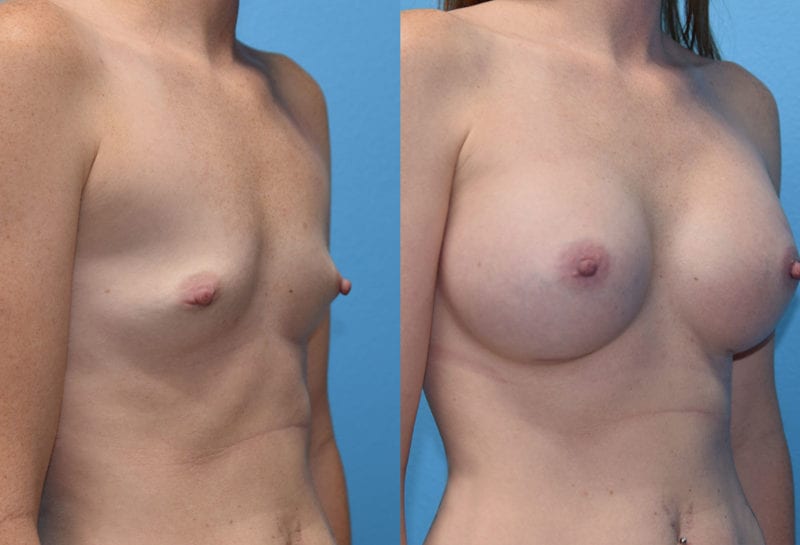 breast augmentation results by dr. maningas at maningas cosmetic surgery in joplin, mo