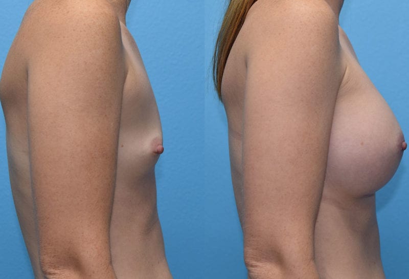 breast augmentation results by dr. maningas at maningas cosmetic surgery in joplin, mo