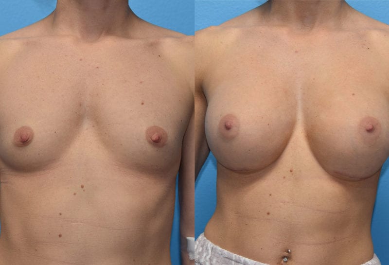 breast augmentation results by dr. maningas at maningas cosmetic surgery in joplin, mo