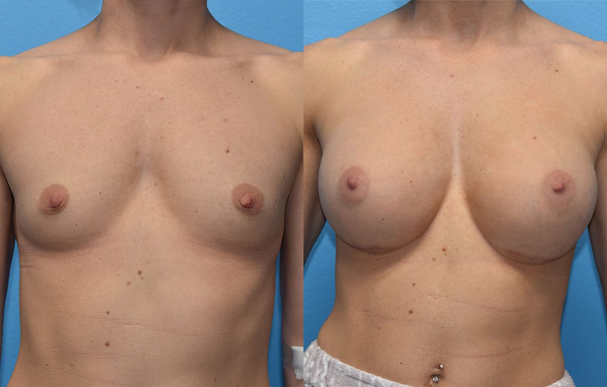 breast augmentation results by dr. maningas at maningas cosmetic surgery in joplin, mo