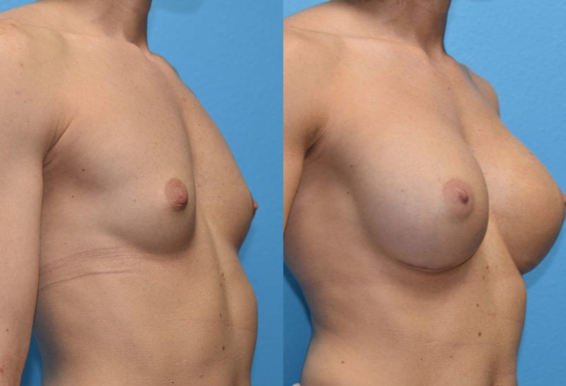 breast augmentation results by dr. maningas at maningas cosmetic surgery in joplin, mo