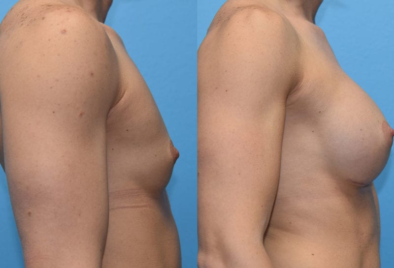 breast augmentation results by dr. maningas at maningas cosmetic surgery in joplin, mo