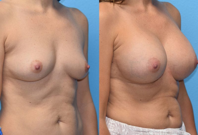 breast augmentation results by dr. maningas at maningas cosmetic surgery in joplin, mo