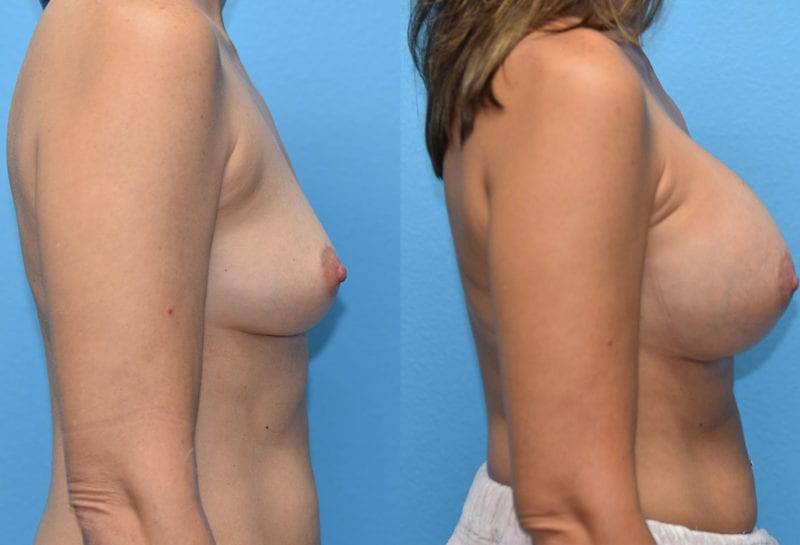 breast augmentation results by dr. maningas at maningas cosmetic surgery in joplin, mo