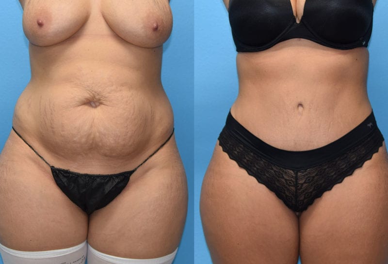 Tummy tuck results by Dr. Maningas at Maningas Cosmetic Surgery in Joplin, MO